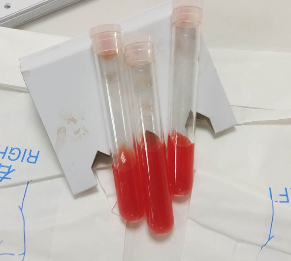 放一张脑脊液的片子.手术只是第一关,哪儿有那么简单就恢复了呢!
