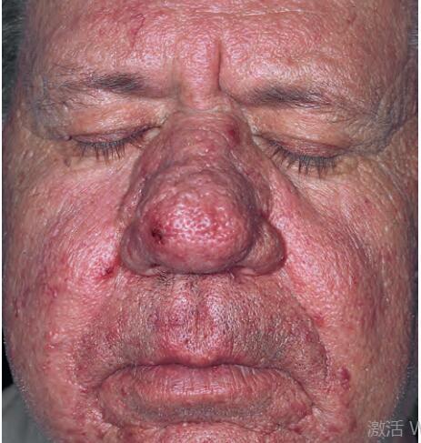 被误解的玫瑰痤疮(酒渣鼻)