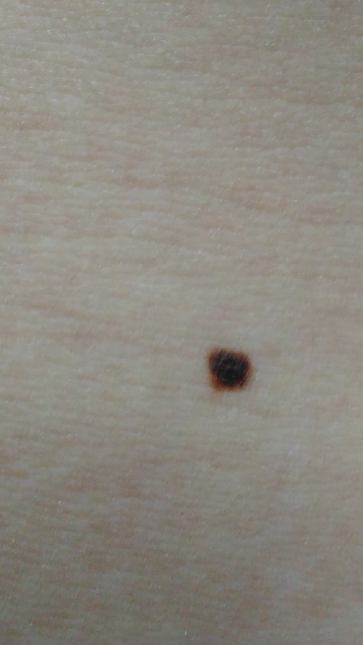 小伙脸上的色斑咋回事