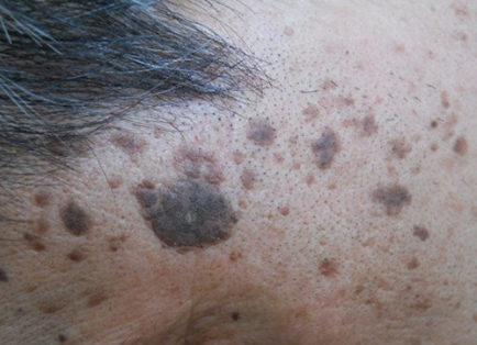 脸上长斑了,哪种治疗方法适合你?