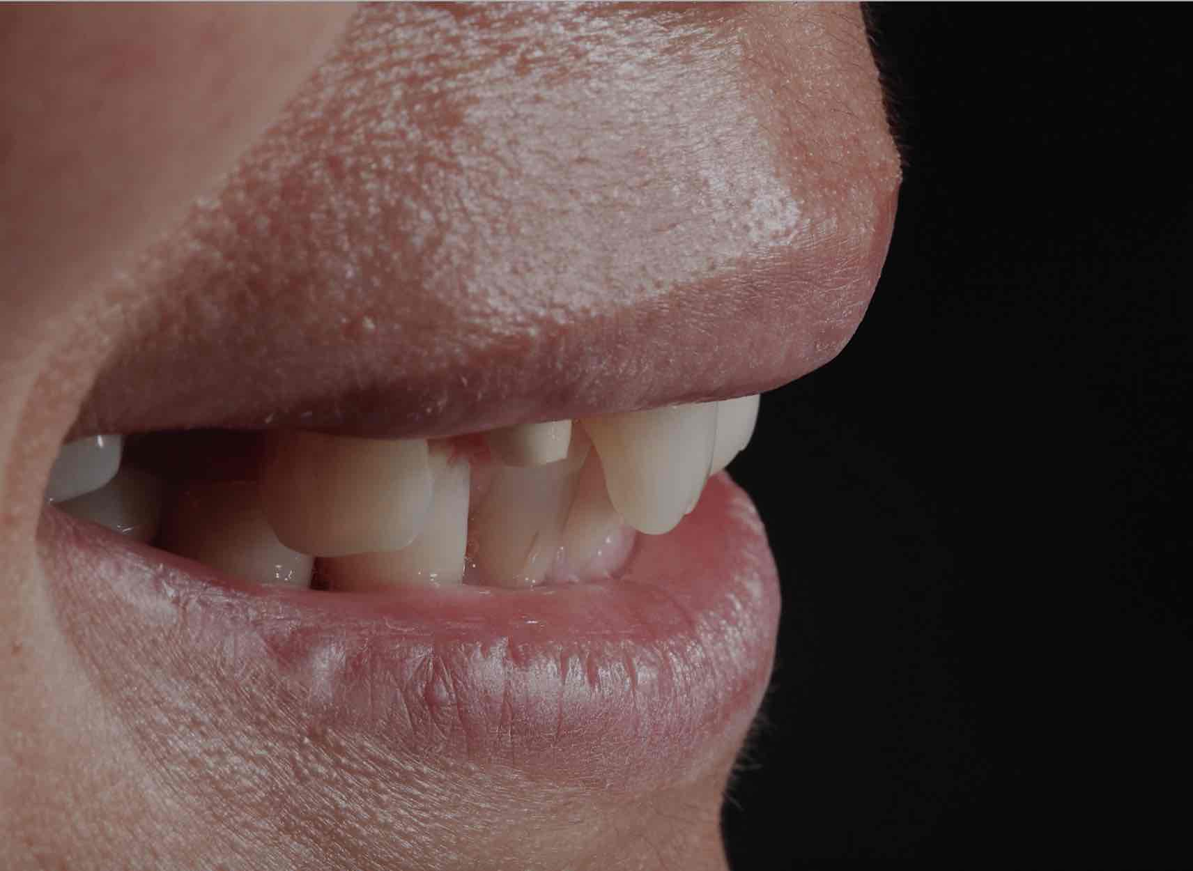 侧面微笑照片备牙后表面抛光排龈照片左侧上颌第一磨牙拔除后历时三个