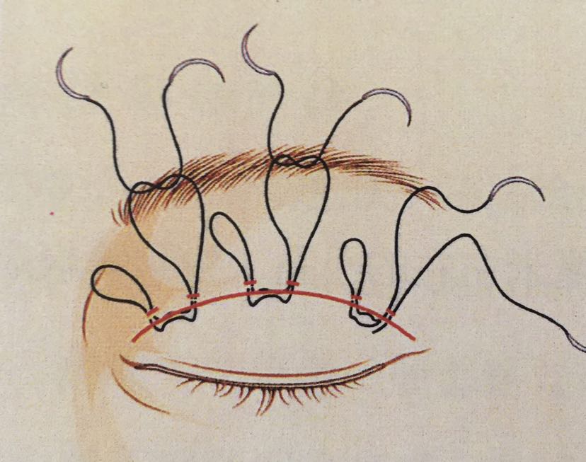 但总体来讲分为埋线法和切开法,埋线法双眼皮手术是利用缝线将提上睑
