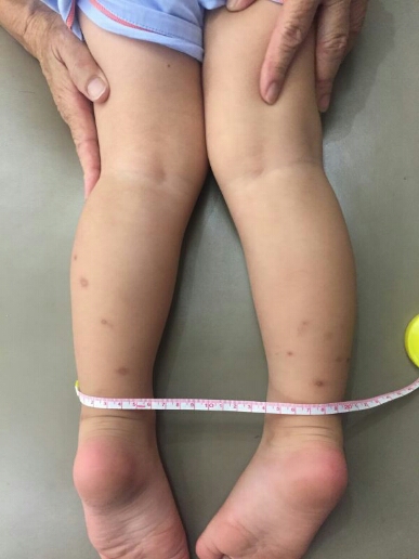 新生儿膝关节反屈图片图片