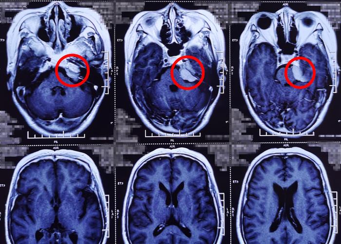 脑瘤的早期症状图片图片