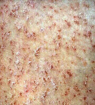 持久性豆状角化过度症