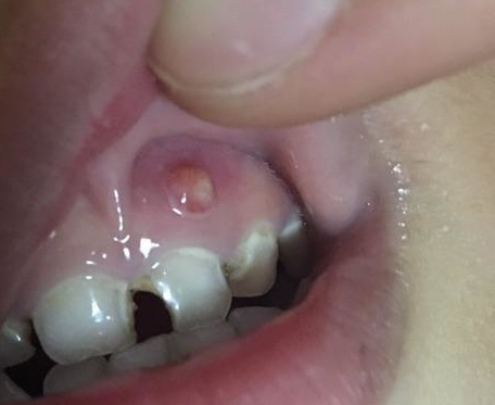儿童牙龈囊肿图片图片