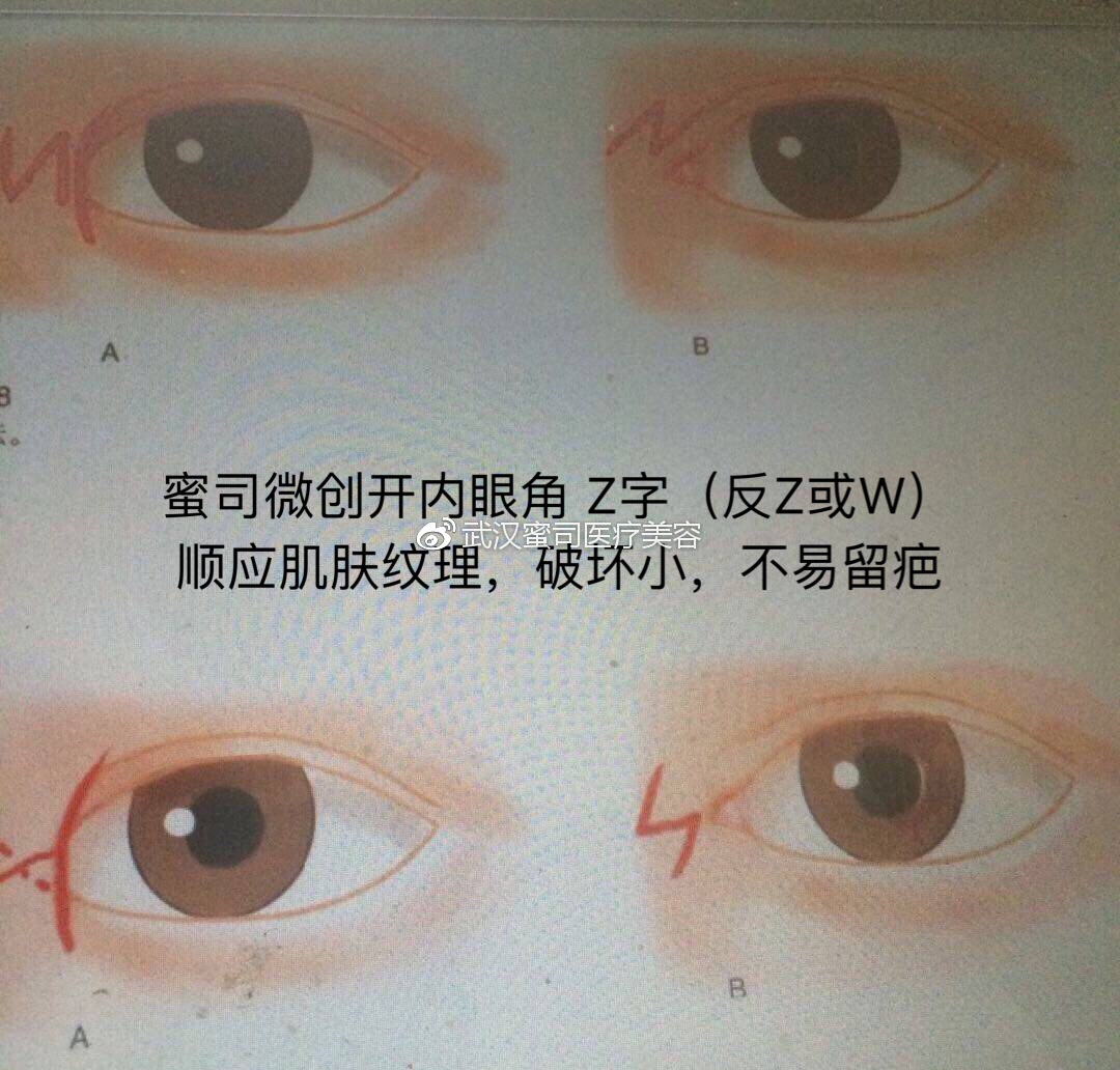 并且切开后要内部松解组织,特别是内眦韧带前的轮匝肌肉,以免张力过大