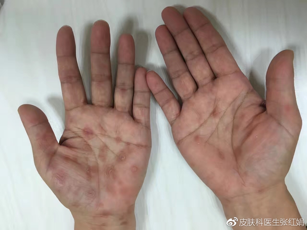 梅毒患者的手和脚图片图片
