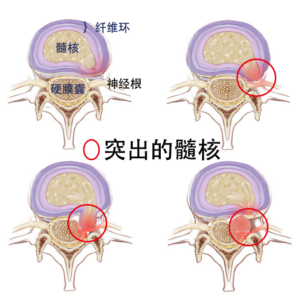 椎间盘由软骨终板,纤维环和髓核构成(如下图.