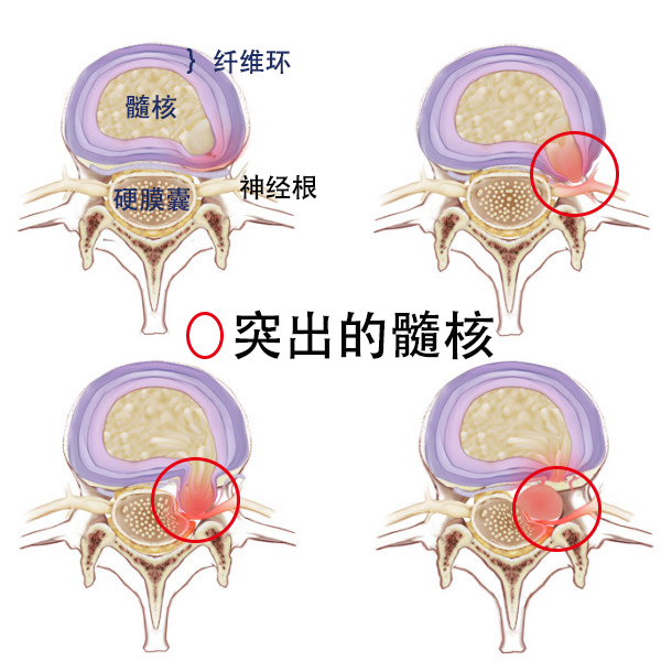 什么是椎间盘突出症