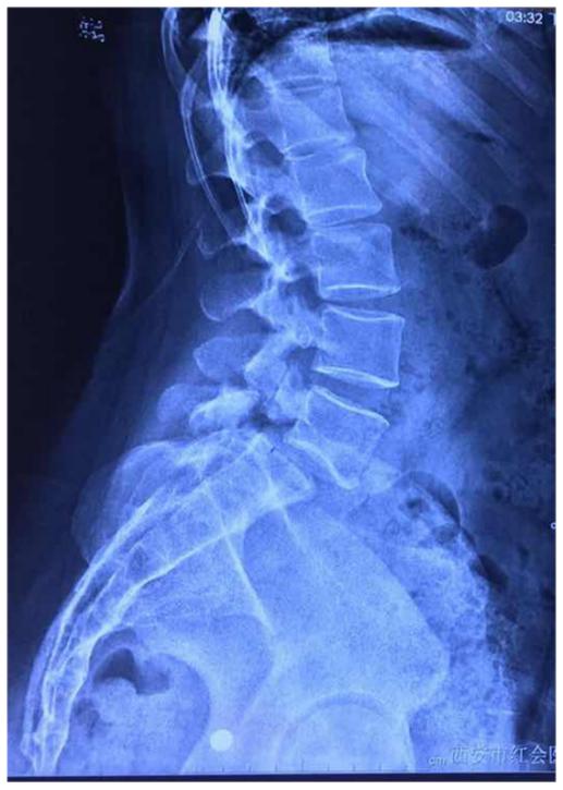 病例:峡部裂导致腰椎滑脱该怎么治疗?