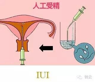 难过!人工授精和试管区别"宝宝教育"-第2张图片-珂润博客