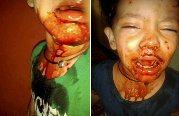 3岁女童疑患罕见血汗症眼耳口每日出血