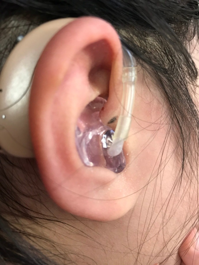 周二日记 耳轮脚黑痣