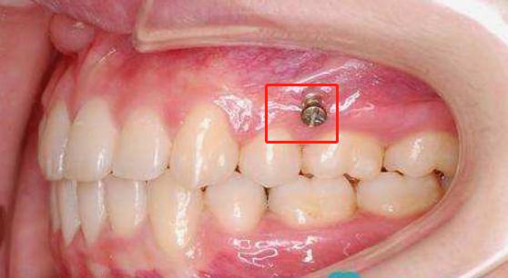 牙齒矯正還要打骨釘?直接打釘子進牙齦不疼嗎?牙醫為你解秘