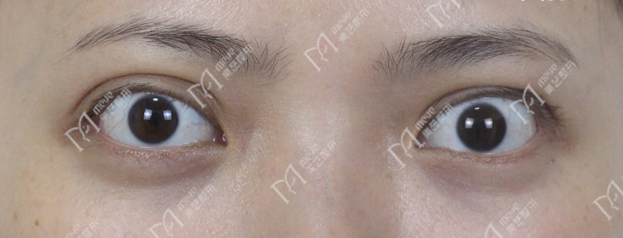 上眼睑退缩也不要忽视