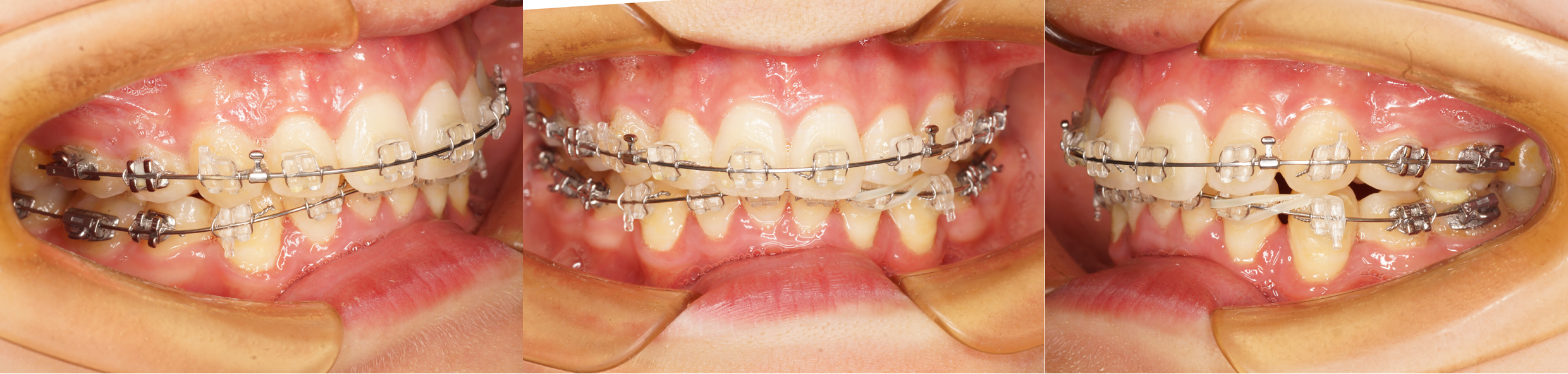 深覆合是啥?需不需矫正,附固定树脂平导制作过程