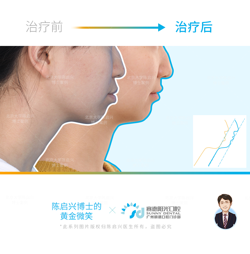 高角骨性下颌后缩矫正案例
