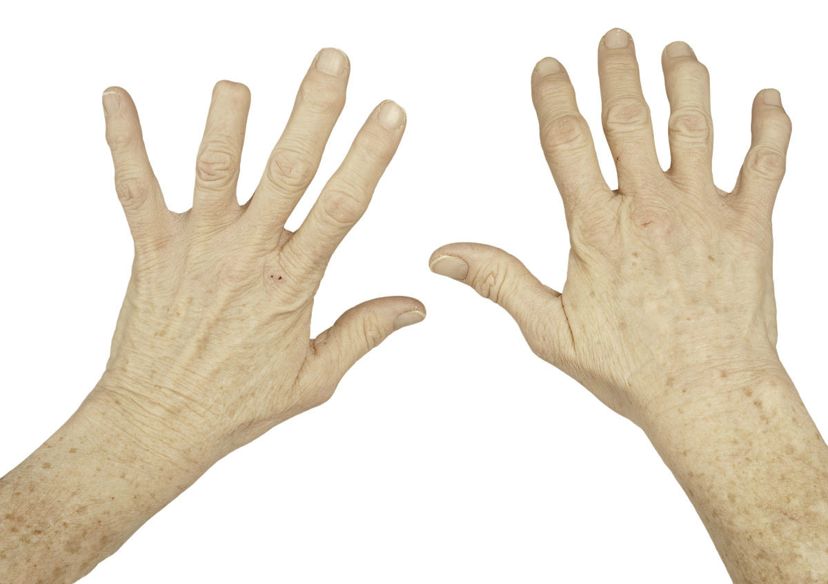 风湿性关节炎疼痛难耐,牢记治疗的7大要点,不然都是白费工夫