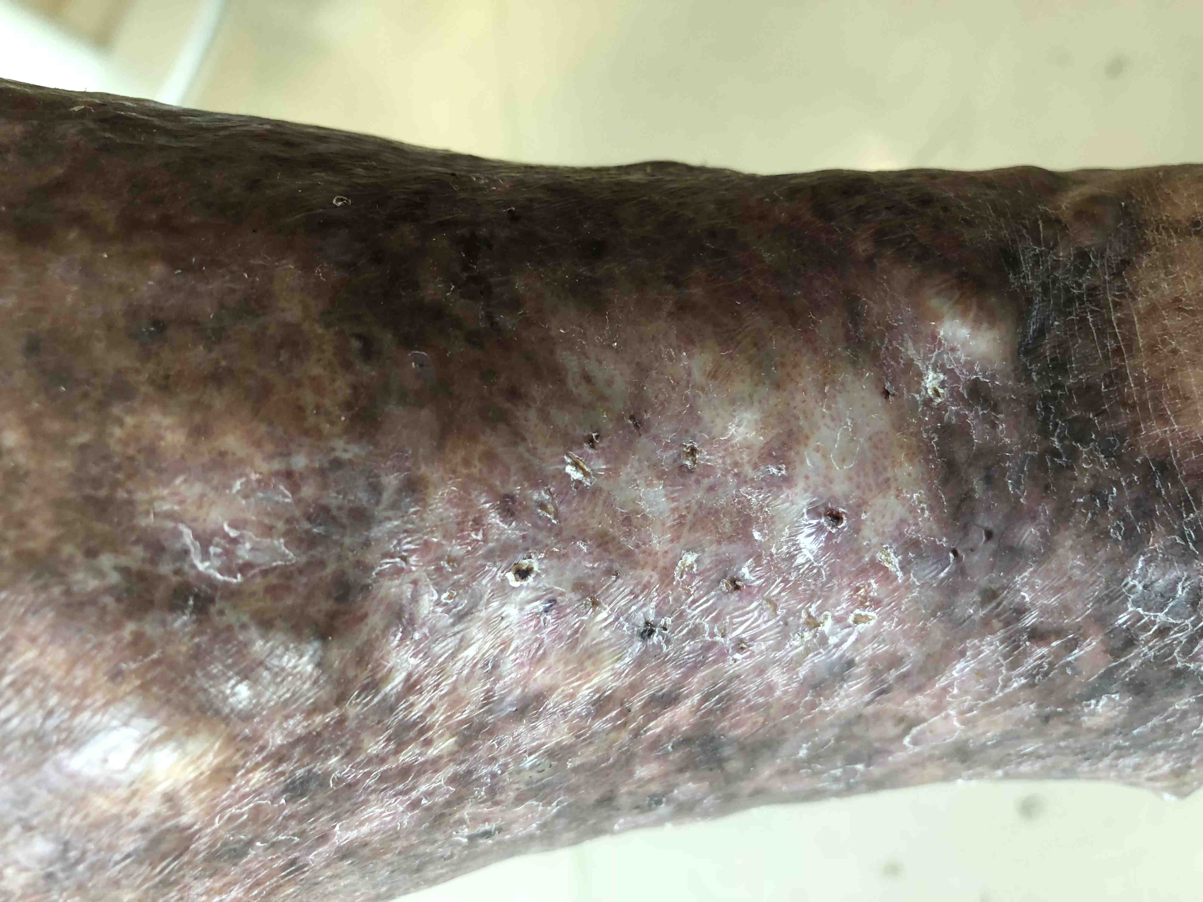 静脉曲张不要拖,否则增加痛苦和手术难度