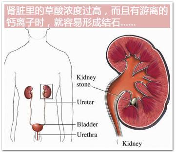 肾结石的常见治疗方法介绍