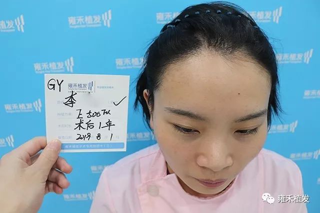 仅500单位雍禾女护士也给自己植发啦13无码图