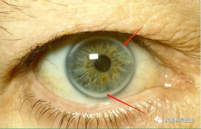 高血脂角膜弓图片图片