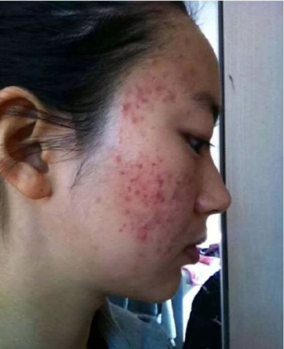 脸上的痤疮多久可以自愈?