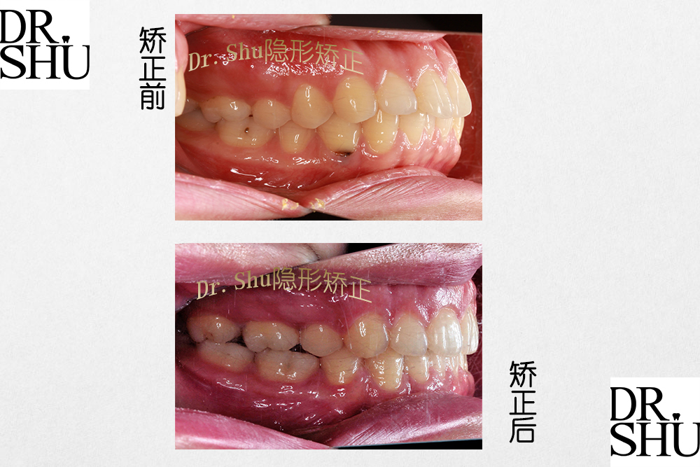 一般而言,牙齒需要通過拔牙矯正時,以第一雙尖牙(虎牙之後的第一顆