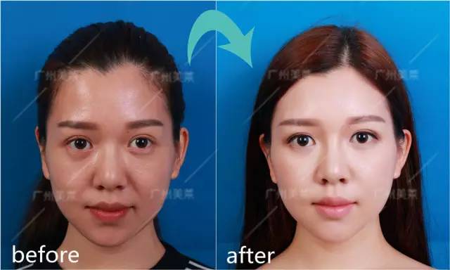 缩小鼻翼一般多少钱_缩小鼻翼成功率高吗_缩小鼻翼需要多少钱