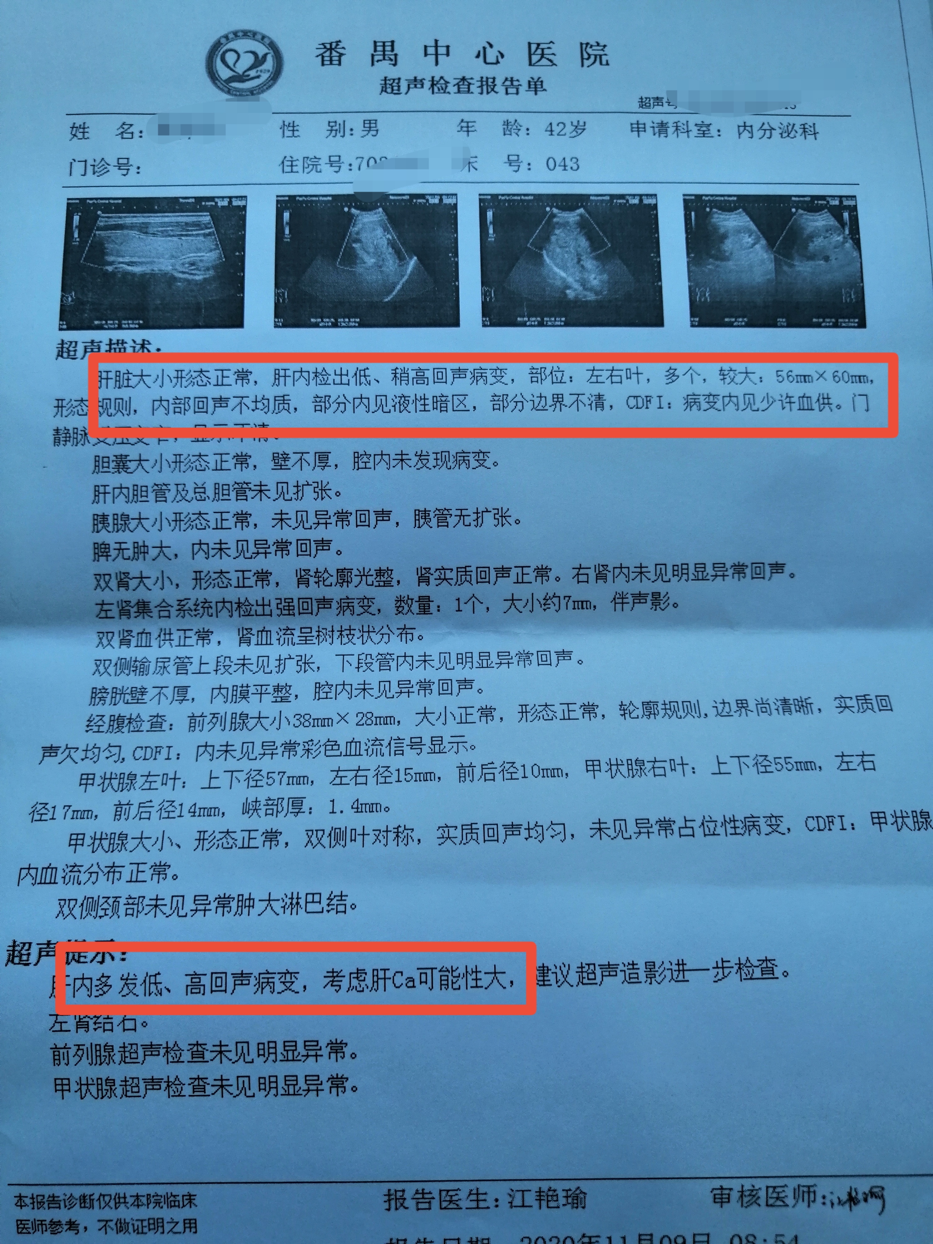 巨块型肝癌病例分享