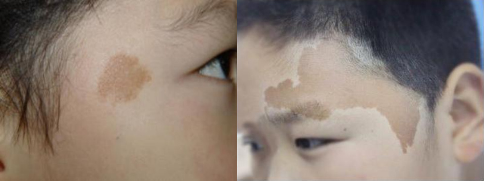 牛奶咖啡斑—浅褐色