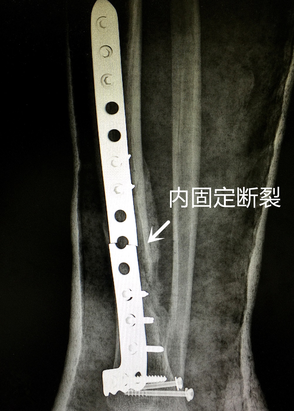 骨折癒合的時間並不是一成不變的,骨折癒合是多因素作用的結果,通常