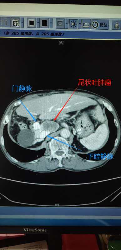 80岁老年男性肝尾状叶切除案例