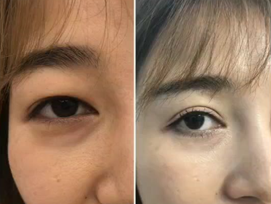 科普|如何判断自身是假性眼袋还是真性眼袋-刘会娜-爱问医生