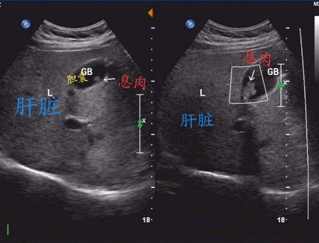 胆囊息肉彩超图片图片