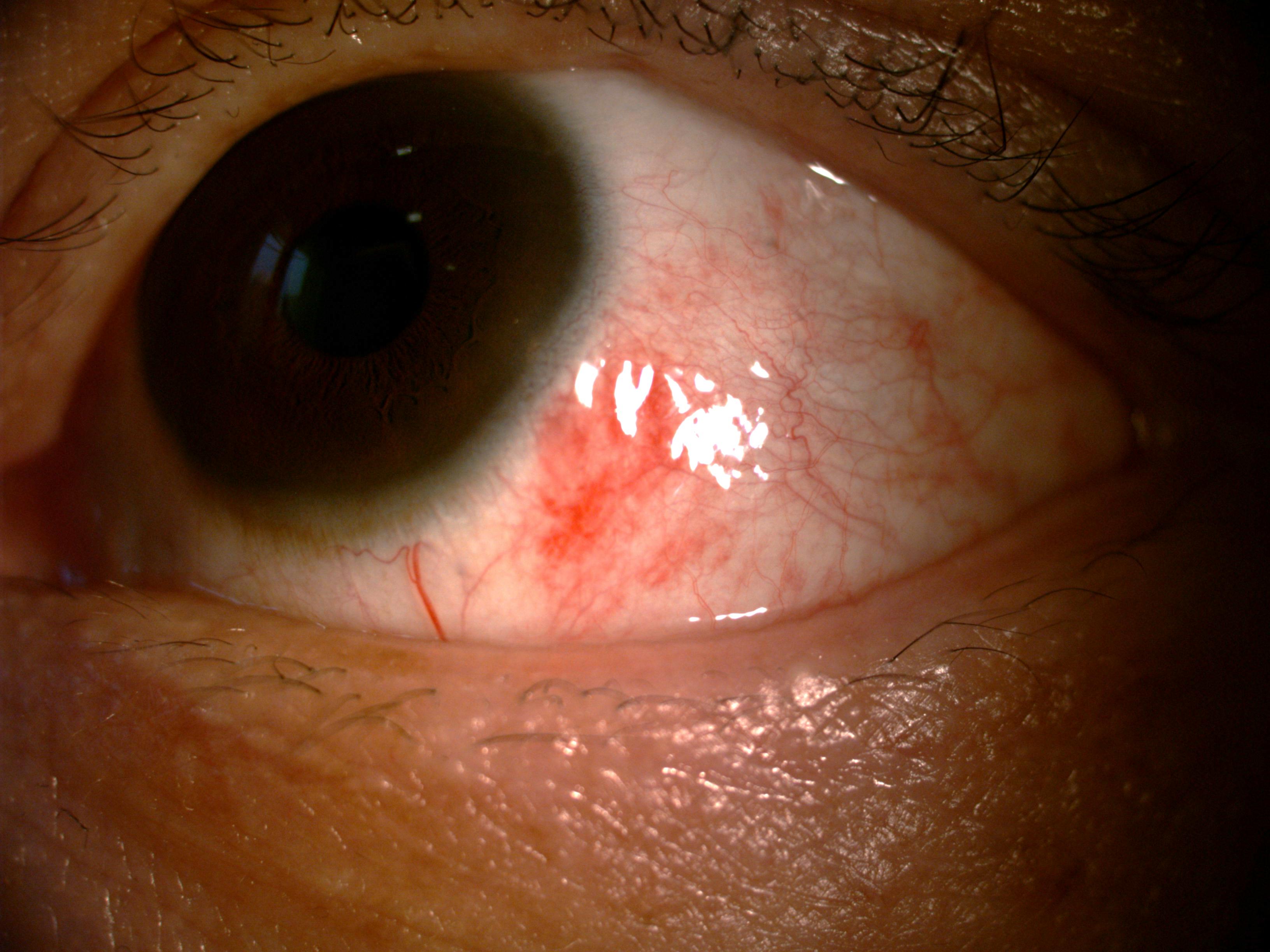 眼科常见病系列结膜下出血1