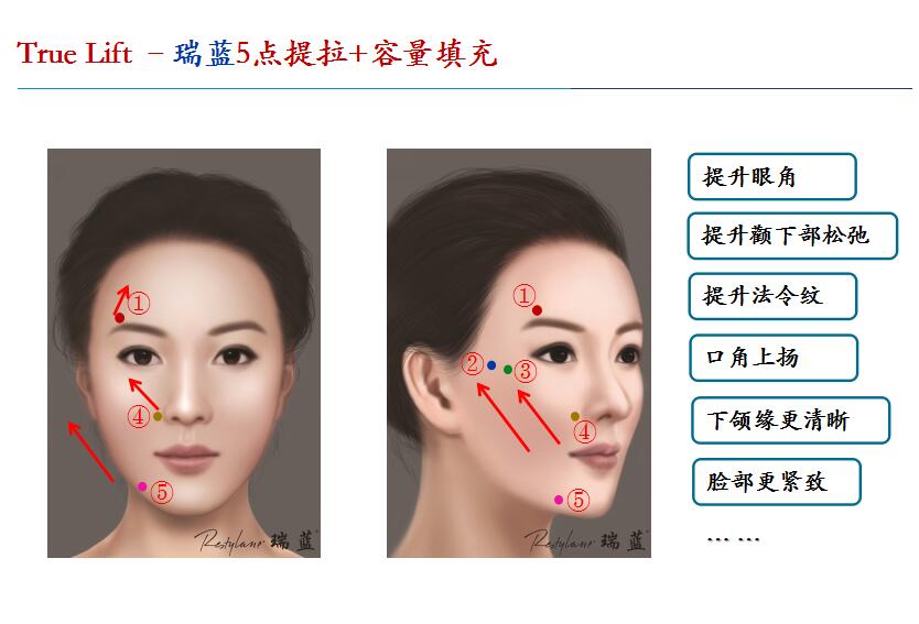 鼻基底玻尿酸注射手法图片