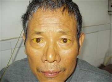 肝硬化有什么蛛丝马迹,肝硬化有三个典型症状