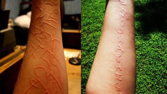 皮肤竟然能写字?小心,这是荨麻疹!