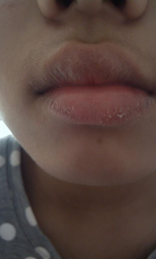 嘴唇边缘脱皮这是怎么了,怎么治 br>