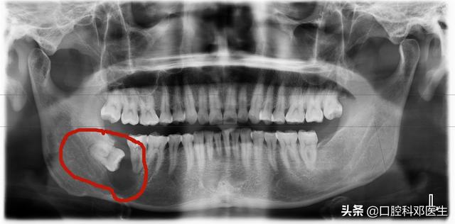 别让埋伏牙成为口腔内u201c地雷u201d，应及时拔除！-邓明辉副主任医师-爱问医生