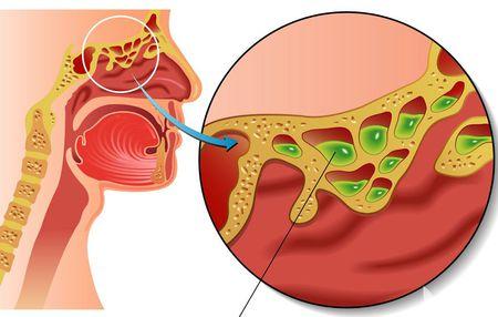 辨别儿童鼻窦炎的窍门