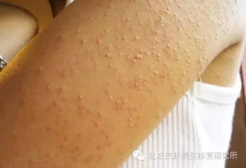 鸡皮肤褐色印(鸡皮肤褐色且平滑)