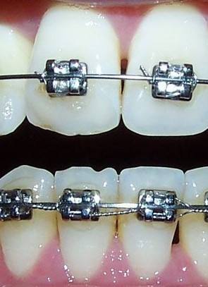 金属矫正-牙面.jpg