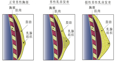 关于男性乳房发育症的6个认识误区