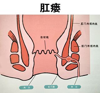 各类肛门疾病图示图片