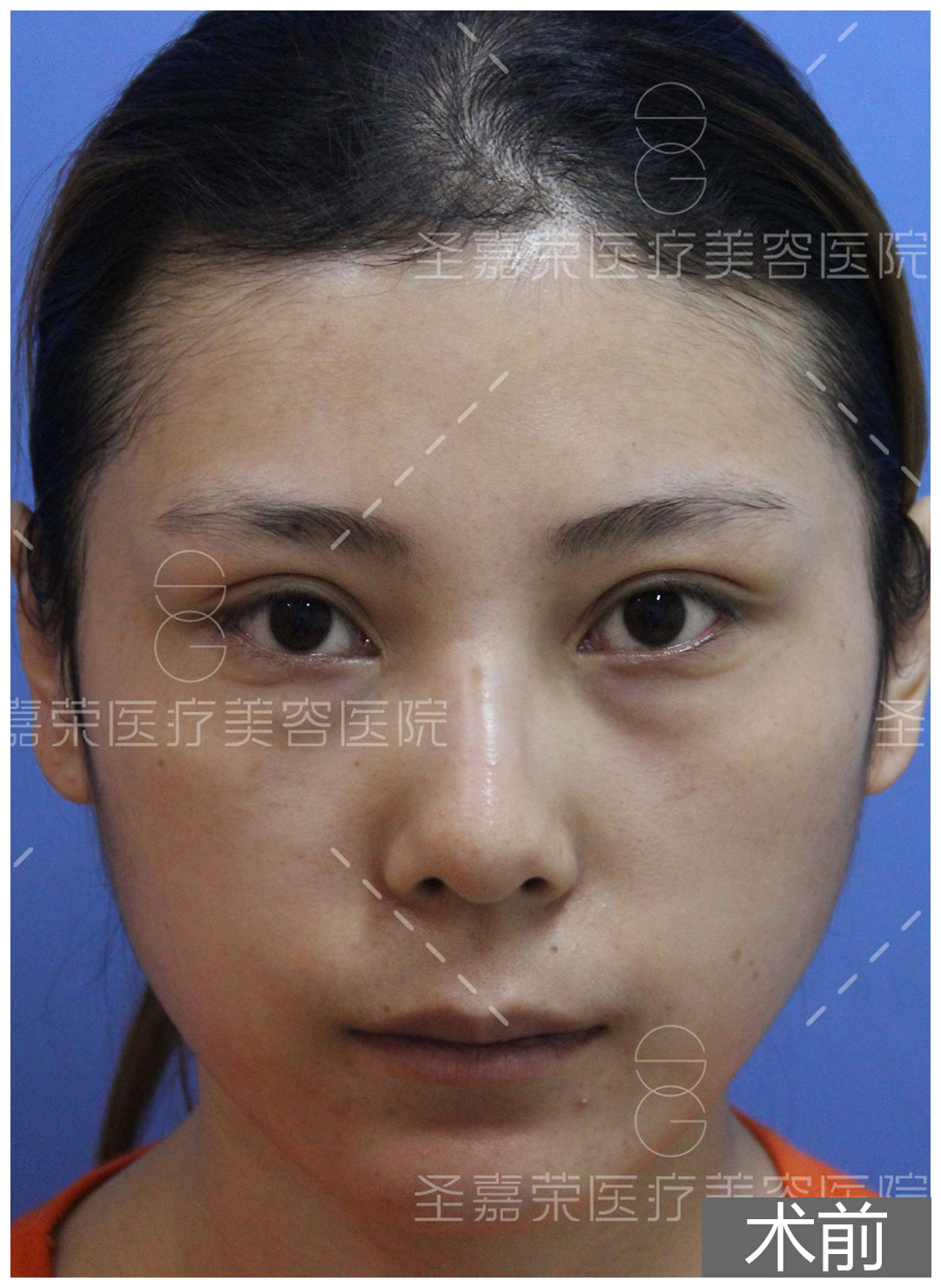 郭鑫医生面部脂肪填充案例一：法令纹（鼻唇沟）填充 - 好大夫在线