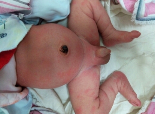 新生儿先天性梅毒图片图片