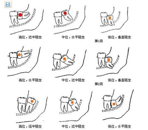 拔智齿到底会不会瘦脸?